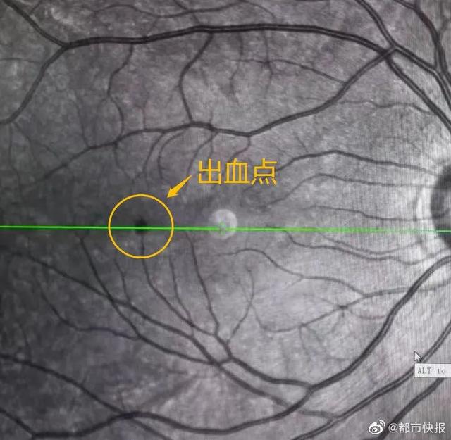 22岁“刘畊宏女孩”跳操3天眼底出血，哪个动作错了？