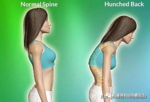 为啥青春期的女孩子驼背多？