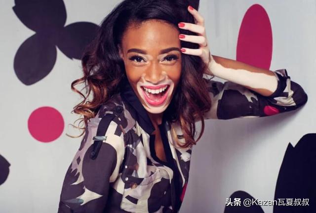 她患有严重的白癜风，但依然成为世界顶级超模，特别的美值得欣赏