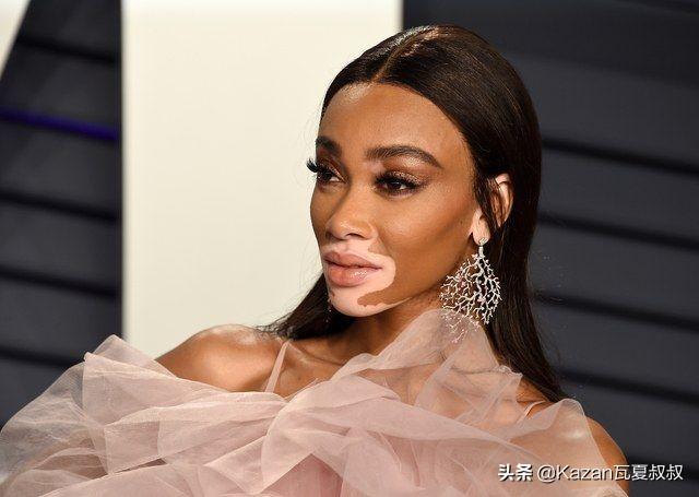 她患有严重的白癜风，但依然成为世界顶级超模，特别的美值得欣赏