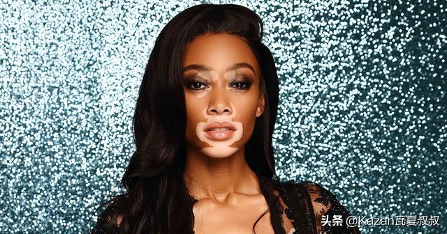 她患有严重的白癜风，但依然成为世界顶级超模，特别的美值得欣赏