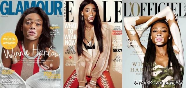 她患有严重的白癜风，但依然成为世界顶级超模，特别的美值得欣赏