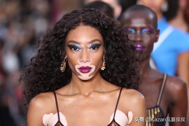 她患有严重的白癜风，但依然成为世界顶级超模，特别的美值得欣赏