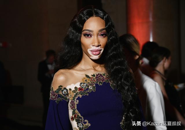 她患有严重的白癜风，但依然成为世界顶级超模，特别的美值得欣赏