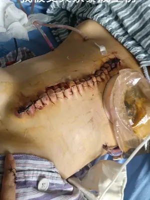 成都美女小谢被丈夫打断肠子，需长期挂粪袋[16P]