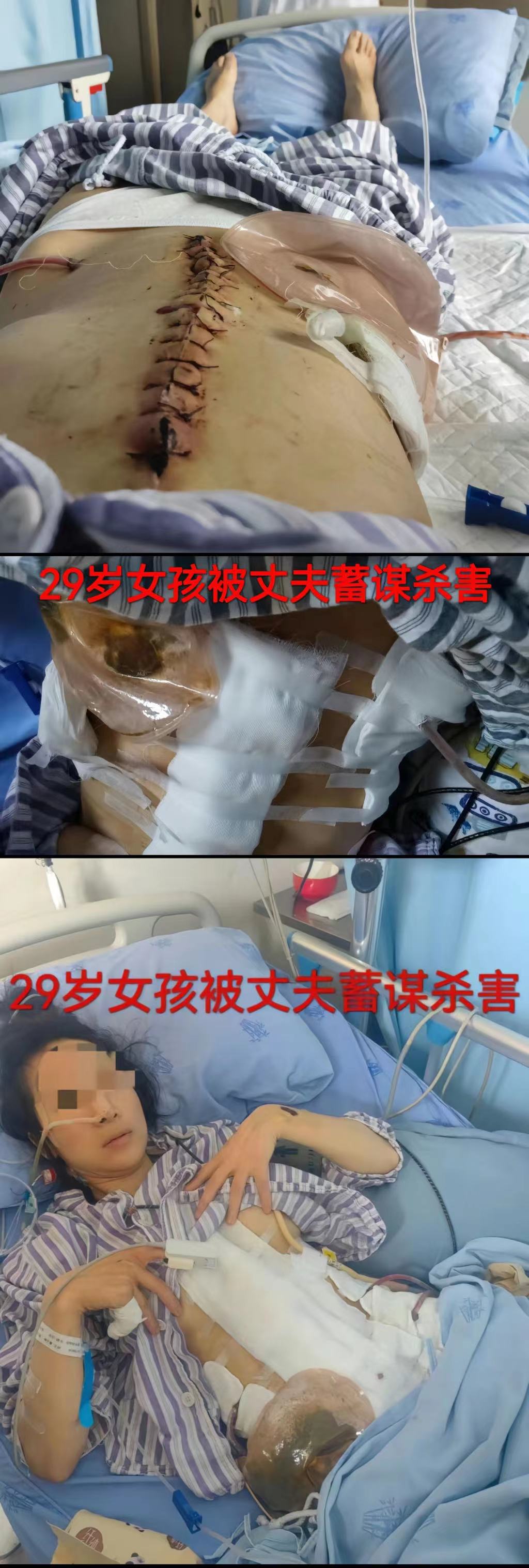 成都美女小谢被丈夫打断肠子，需长期挂粪袋[16P]