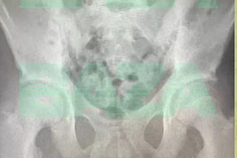 将三块“小磁铁”塞进阴茎后,小伙子的膀胱“几乎爆炸”