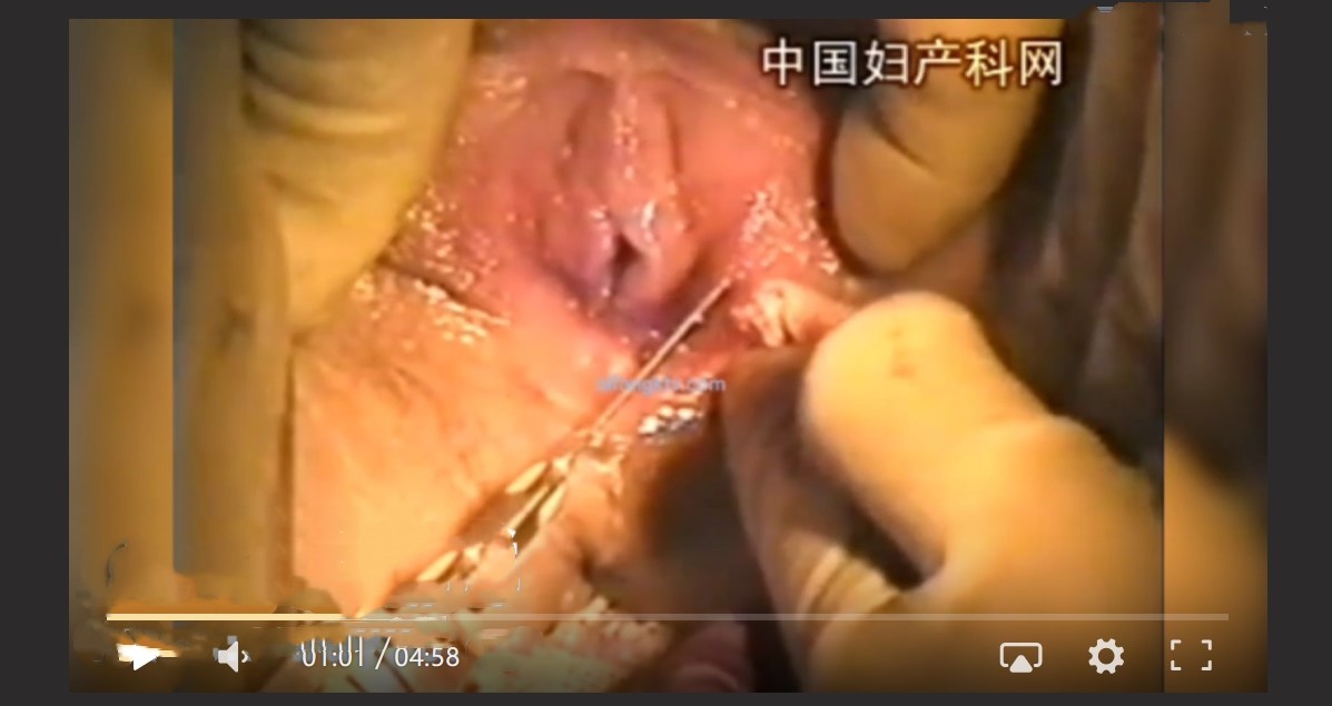 如何分辨纯天然处女和后期人工手术修复的处女膜 给狼友们科普下小知识