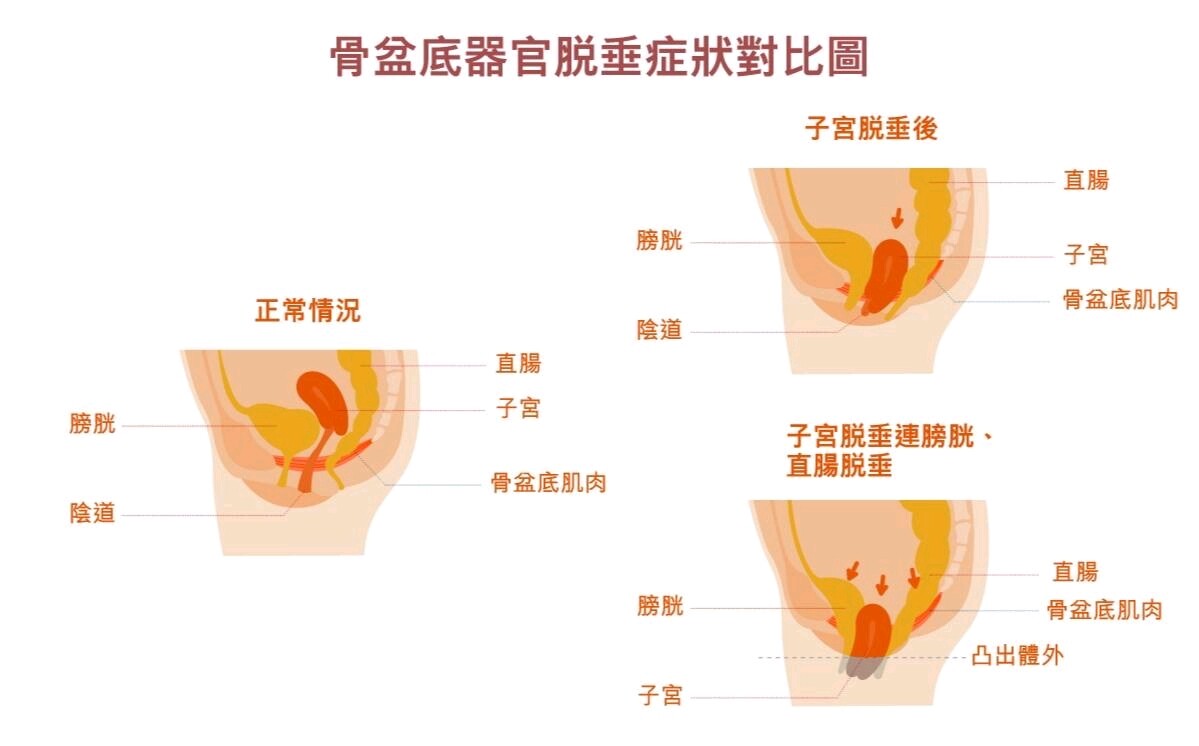 男女双修的 PC 肌训练