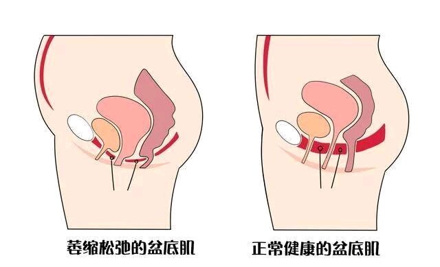 男女双修的 PC 肌训练