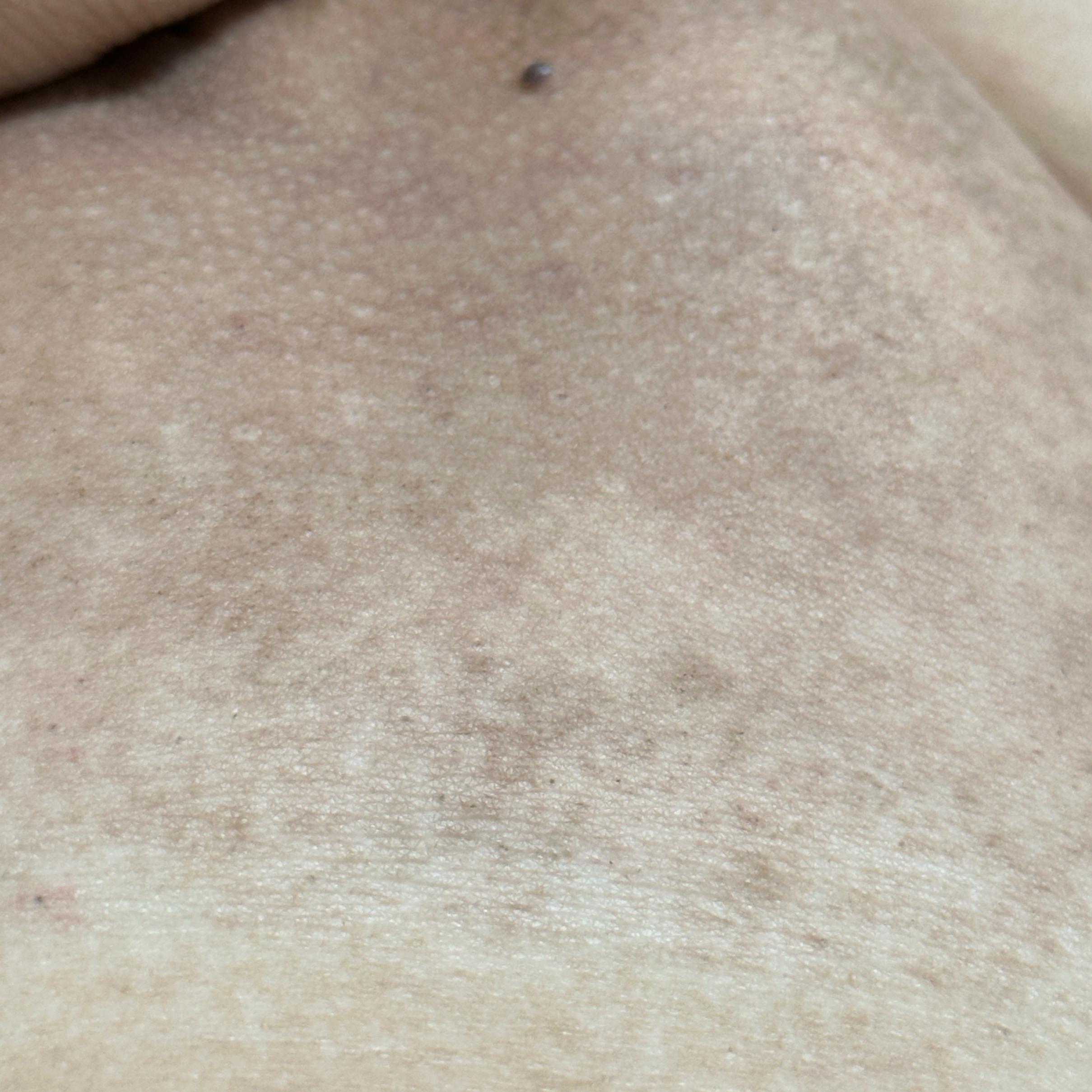 脱毛方法试了无数次这次应该是能绝毛的节奏、分享给大家看看效果