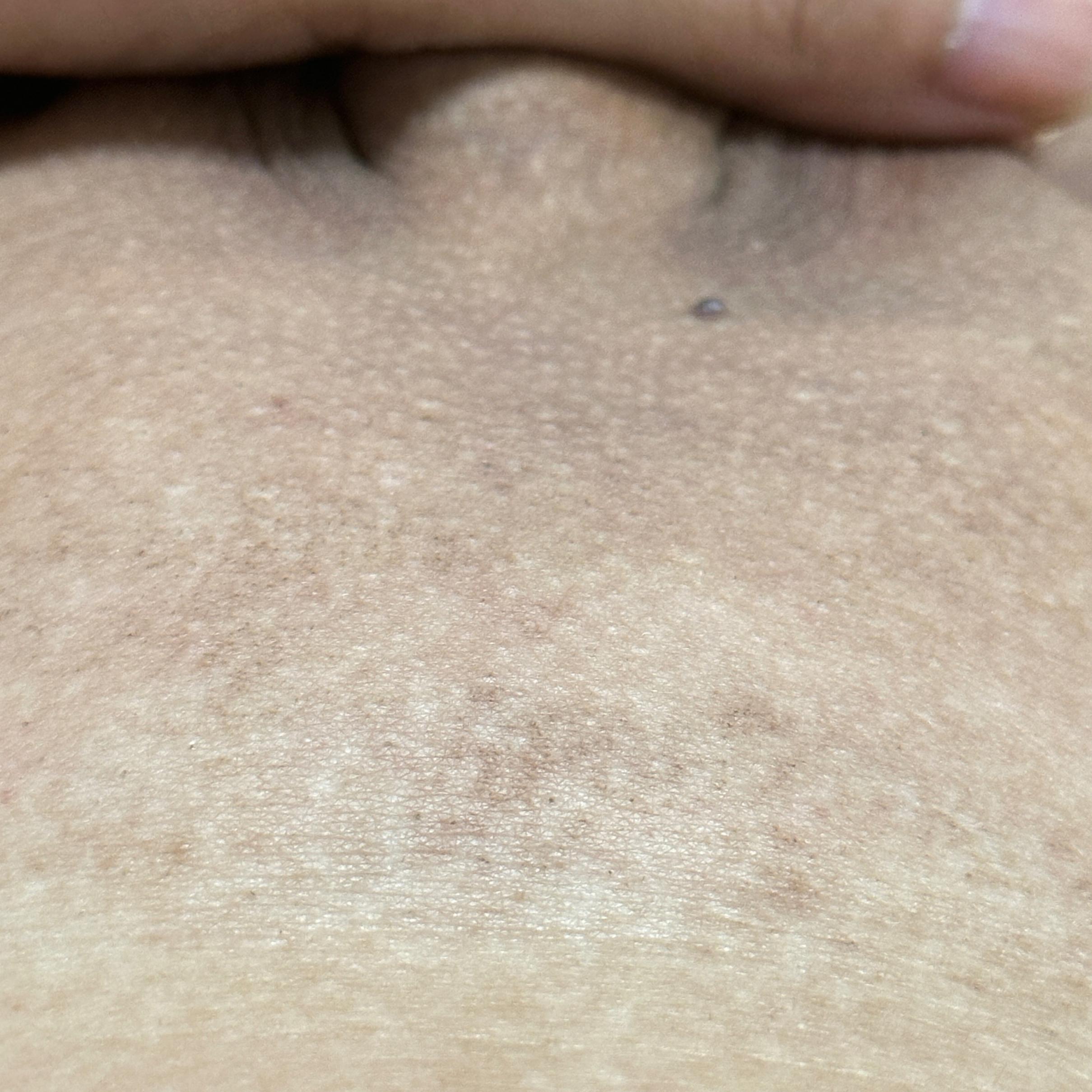 脱毛方法试了无数次这次应该是能绝毛的节奏、分享给大家看看效果