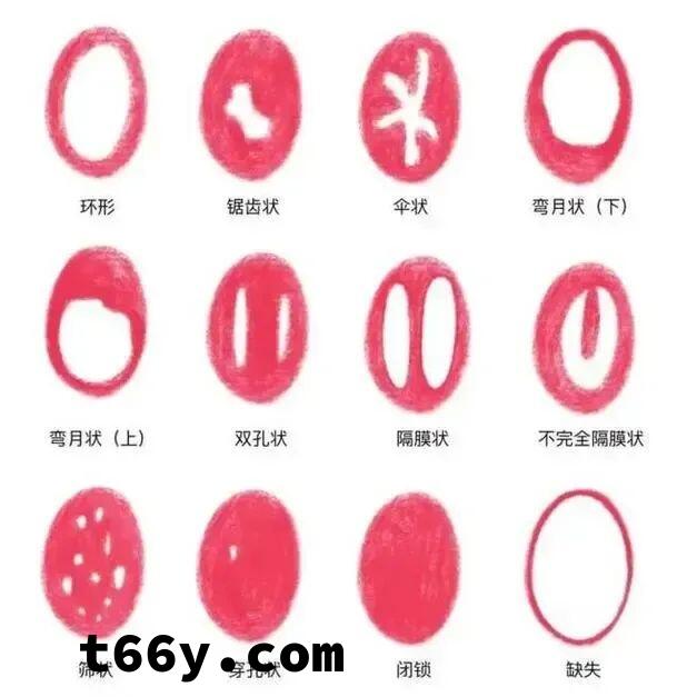 处女膜到底长什么样，看实物