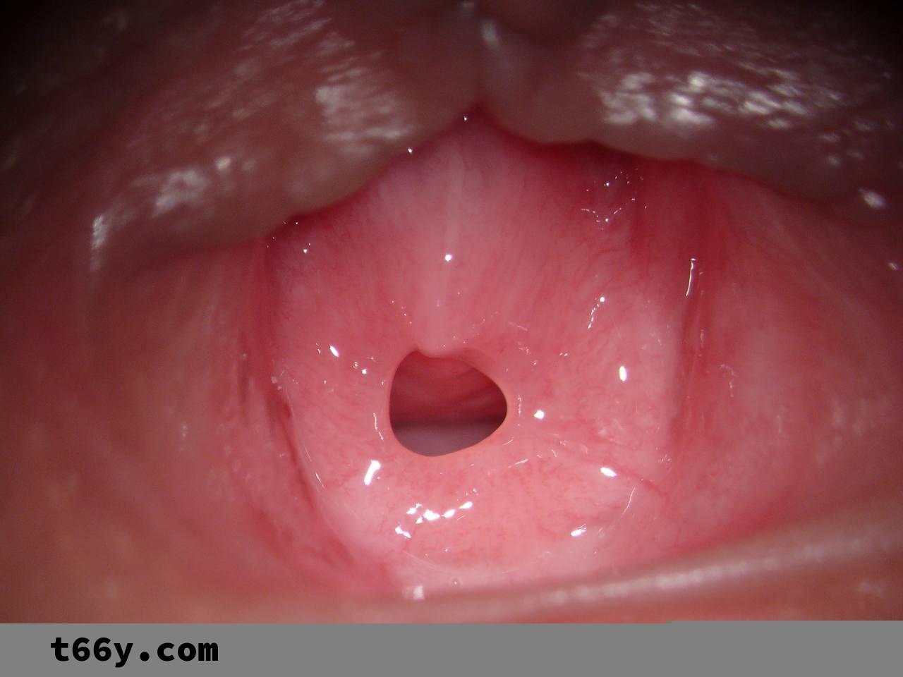 处女膜到底长什么样，看实物